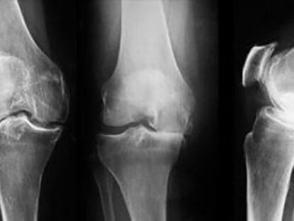 Artroza, Movial Plus,