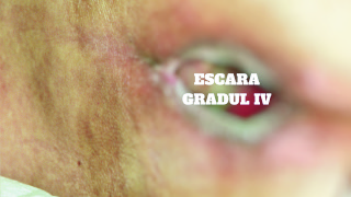 Escare, rana, Hartmann,