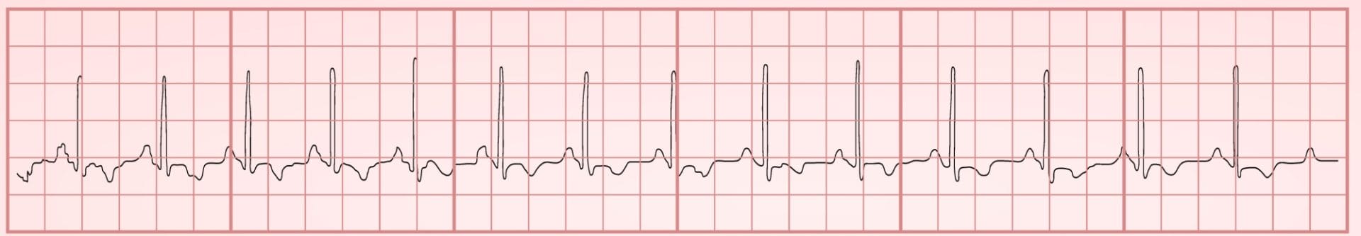 EKG