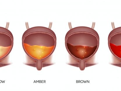 culoarea urinei, urina,