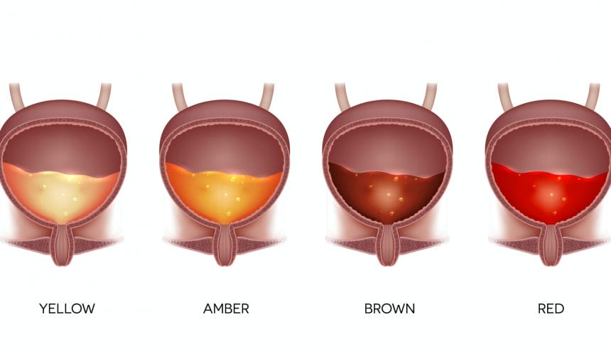 culoarea urinei, urina,