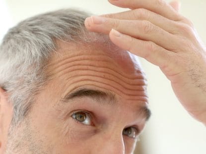 tratament alopecie, alopecia, celule progenitoare, Rigenera,