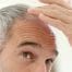 tratament alopecie, alopecia, celule progenitoare, Rigenera,