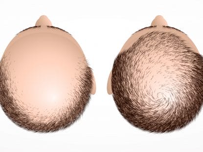 alopecie, celule progenitoare, Rigenera,