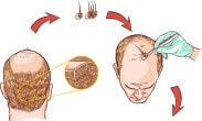 Tratament chirurgical in alopecie
