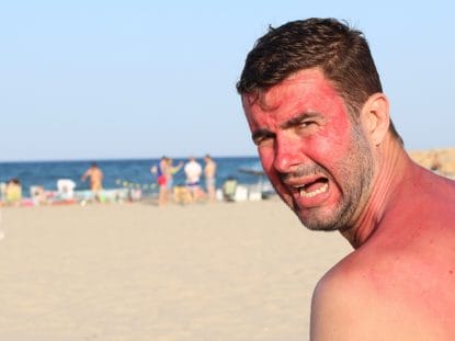 insolatia, hipertermia,