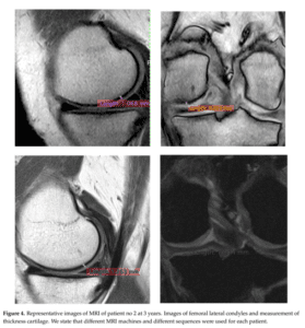 Tratament artroza Rigenera caz III