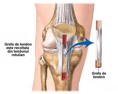 Autogrefa de tendon patelar in ruptura ligamentului incrucisat anterior