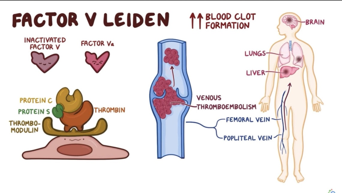 Tromboza venoasa profunda - Factor V Leiden