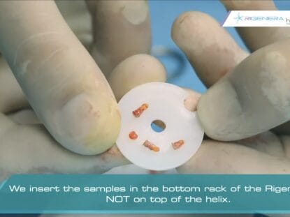 Tratament pentru alopecie, celule progenitoare,