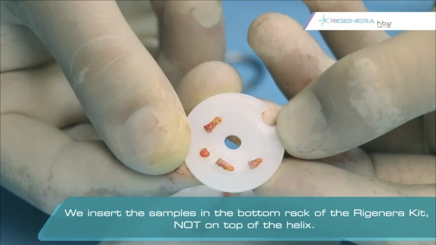 Tratament pentru alopecie, celule progenitoare,