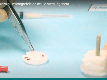 Tratament artroza, celule progenitorii,