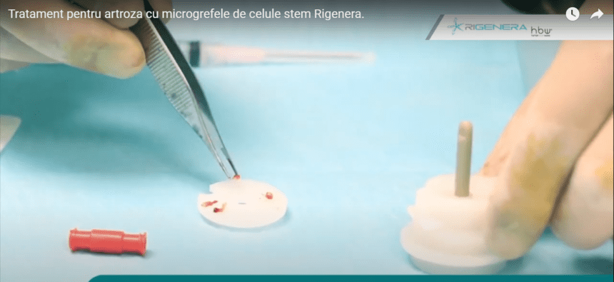 Tratament artroza, celule progenitorii,