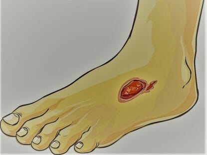 piciorul diabetic, celule mezenchimale, Rigenera,