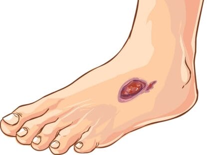 piciorul diabetic, celule mezenchimale, Rigenera,