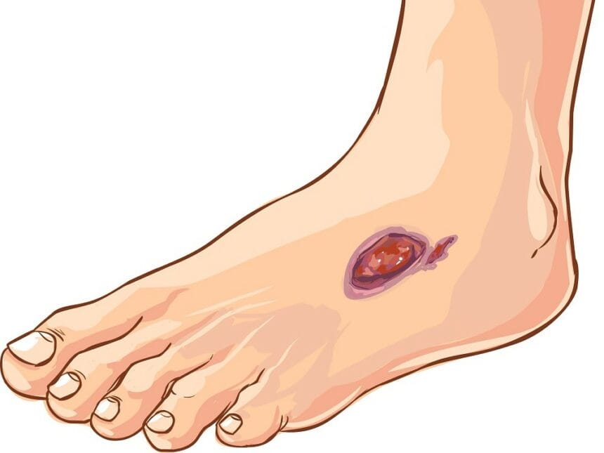 piciorul diabetic, celule mezenchimale, Rigenera,