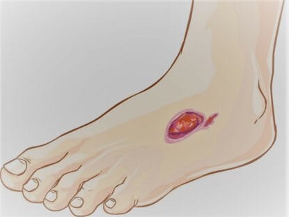 piciorul diabetic, celule mezenchimale, Rigenera,