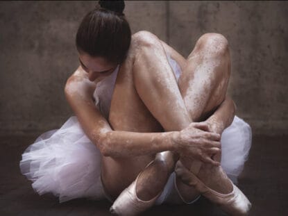 Tratament, vitiligo, Rigenera,