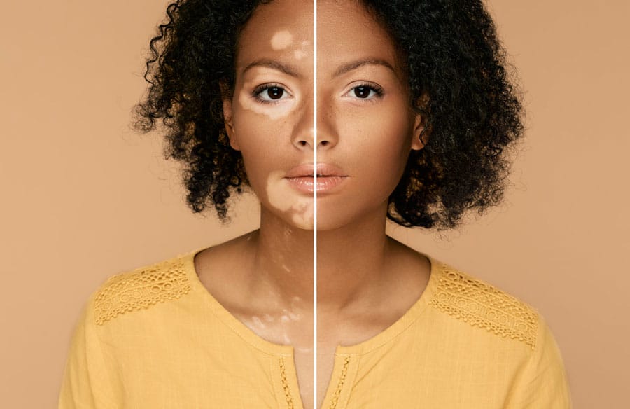 Adaptare la noua realitate, vitiligo,