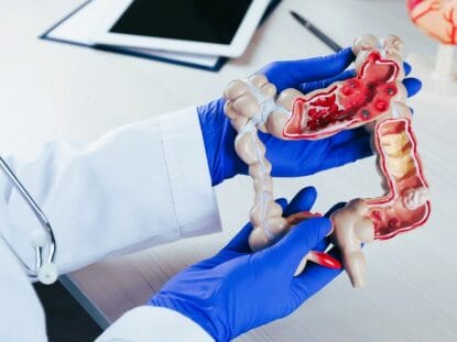 apendicita, peritonita, apendice,