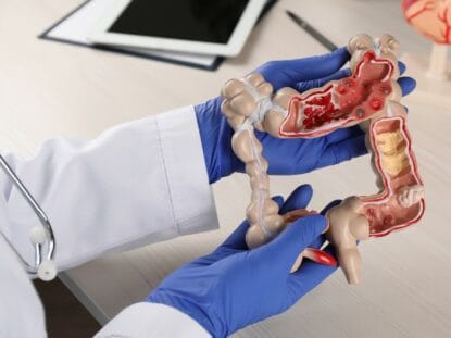 apendicita, peritonita, apendice,