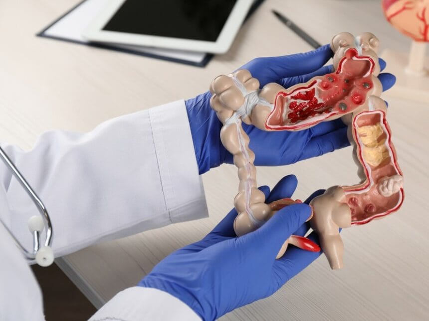 apendicita, peritonita, apendice,