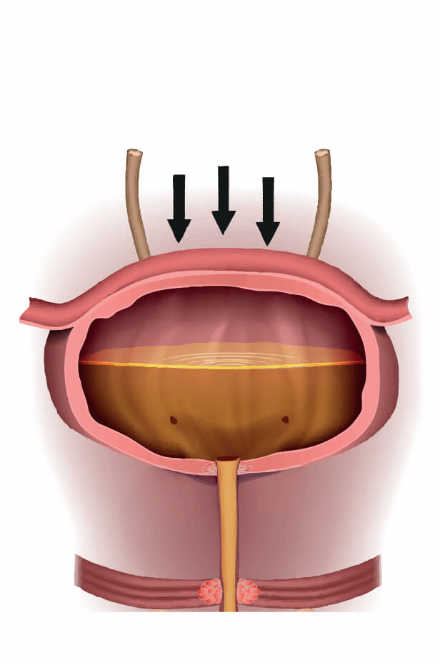incontinenta urinara de stres
