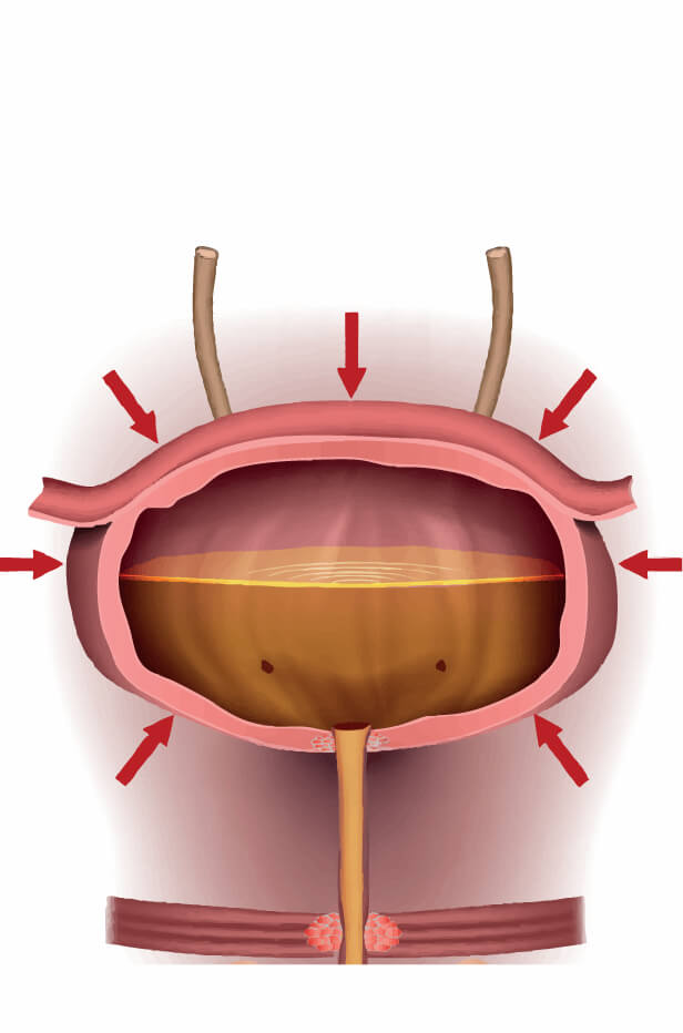 INCONTINENTA URINARA IMPERIOASA